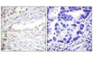 Immunohistochemistry analysis of paraffin-embedded human lung carcinoma tissue using Uba2 antibody. (UBA2 antibody  (C-Term))
