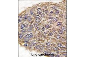 Formalin-fixed and paraffin-embedded human lung carcinoma tissue reacted with ALDOA antibody , which was peroxidase-conjugated to the secondary antibody, followed by DAB staining. (Aldolase antibody  (N-Term))