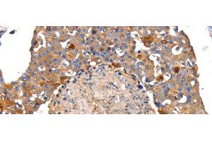 Immunohistochemistry of paraffin-embedded Human breast cancer tissue using IRS2 Polyclonal Antibody at dilution 1:100 (IRS2 antibody)