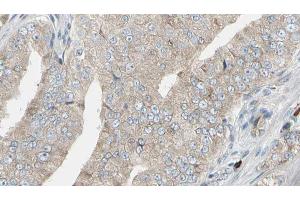 ABIN6272945 at 1/100 staining Human prostate tissue by IHC-P. (LDHB antibody  (N-Term))
