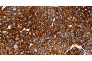 Immunohistochemistry of paraffin-embedded Human breast cancer tissue using EDAR Polyclonal Antibody at dilution 1:45 (EDAR antibody)
