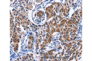 Immunohistochemistry of Human breast cancer using MYH1 Polyclonal Antibody at dilution of 1:40