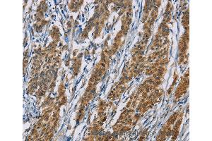 Immunohistochemistry of Human thyroid cancer using ACVR1 Polyclonal Antibody at dilution of 1:60 (ACVR1 antibody)