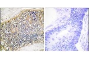 Immunohistochemistry analysis of paraffin-embedded human colon carcinoma tissue, using TALL-2 Antibody. (TNFSF13 antibody  (AA 151-200))