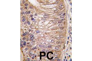 Formalin-fixed and paraffin-embedded human prostate carcinoma tissue reacted with PSCA polyclonal antibody  , which was peroxidase-conjugated to the secondary antibody, followed by DAB staining.
