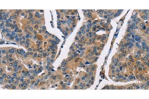 Immunohistochemistry of paraffin-embedded Human breast cancer using CBR1 Polyclonal Antibody at dilution of 1:40 (CBR1 antibody)