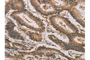 The image on the left is immunohistochemistry of paraffin-embedded Human colon cancer tissue using ABIN7190296(CLEC5A Antibody) at dilution 1/20, on the right is treated with synthetic peptide. (CLEC5A antibody)