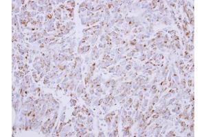 IHC-P Image Immunohistochemical analysis of paraffin-embedded U87 xenograft, using G6PD, antibody at 1:300 dilution. (Glucose-6-Phosphate Dehydrogenase antibody)