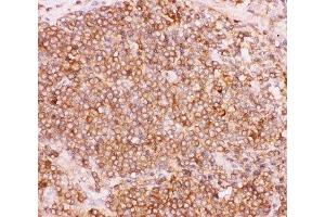 IHC-P: NFKB2 antibody testing of human lung cancer tissue (NFKB2 antibody  (AA 1-340))