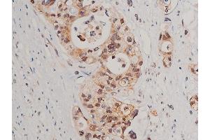 ABIN6254994 and ABIN6267520 at 1/50 staining human colon cancer tissue sections by IHC-P. (Caspase 3 antibody  (pSer150))