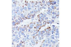Immunohistochemistry of paraffin-embedded human liver cancer using CCDC6 antibody (ABIN7266442) at dilution of 1:100 (40x lens). (CCDC6 antibody  (AA 55-222))