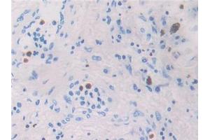 DAB staining on IHC-P; Samples: Human Lung cancer Tissue (CCL26 antibody  (AA 24-94))