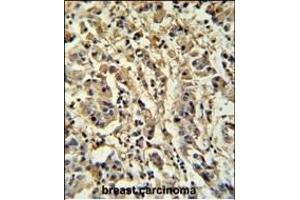Sirt3 Antibody (C-term) (ABIN652184 and ABIN2840670) IHC analysis in formalin fixed and paraffin embedded human breast carcinoma followed by peroxidase conjugation of the secondary antibody and DAB staining.