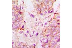 Immunohistochemical analysis of Cytochrome P450 51A1 staining in human prostate cancer formalin fixed paraffin embedded tissue section. (CYP51A1 antibody)