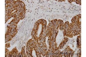 Immunoperoxidase of monoclonal antibody to SH3BP5 on formalin-fixed paraffin-embedded human colon adenocarcinoma. (SH3BP5 antibody  (AA 4-112))