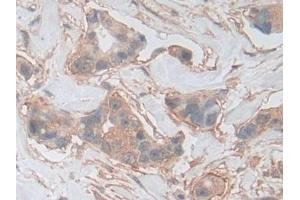 Detection of PKBg in Human Breast cancer Tissue using Polyclonal Antibody to Protein Kinase B Gamma (PKBg) (AKT3 antibody  (AA 46-338))