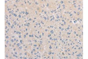 The image on the left is immunohistochemistry of paraffin-embedded Human liver cancer tissue using ABIN7129533(FNTA Antibody) at dilution 1/30, on the right is treated with fusion protein.