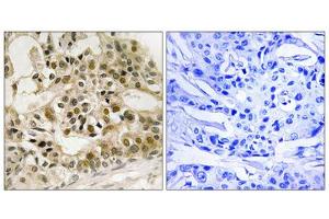 Immunohistochemistry analysis of paraffin-embedded human breast carcinoma tissue using Myb (Phospho-Ser532) antibody. (MYB antibody  (pSer532))