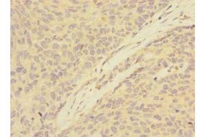 Immunohistochemistry of paraffin-embedded human ovarian cancer using ABIN7144788 at dilution of 1:100 (Ataxin 1 antibody  (AA 346-475))