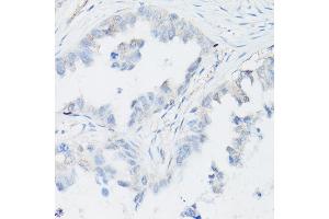 Immunohistochemistry of paraffin-embedded Human lung adenocarcinoma (negative control sample) using p63 Rabbit mAb (ABIN7271099) at dilution of 1:100 (40x lens). (p63 antibody)