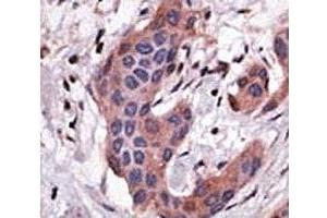 IHC analysis of FFPE human breast carcinoma tissue stained with the Bid antibody (BID antibody  (AA 68-103))