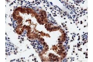 Immunohistochemical staining of paraffin-embedded Adenocarcinoma of Human endometrium tissue using anti-QPRT mouse monoclonal antibody. (QPRT antibody)