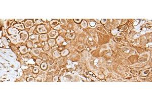 Immunohistochemistry of paraffin-embedded Human esophagus cancer tissue using IL6ST Polyclonal Antibody at dilution of 1:40(x200) (CD130/gp130 antibody)