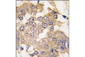 Formalin-fixed and paraffin-embedded human breast carcinoma tissue reacted with ERK2 antibody (C-term), which was peroxidase-conjugated to the secondary antibody, followed by DAB staining. (ERK2 antibody  (C-Term))
