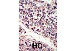 Formalin-fixed and paraffin-embedded human hepatocellular carcinoma tissue reacted with NTRK3 polyclonal antibody  , which was peroxidase-conjugated to the secondary antibody, followed by DAB staining. (NTRK3 antibody  (N-Term))