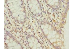 Immunohistochemistry of paraffin-embedded human colon cancer using ABIN7164341 at dilution of 1:100 (DDX2 (AA 25-280) antibody)