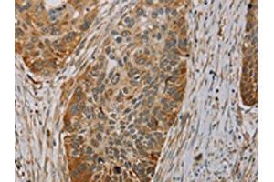 The image on the left is immunohistochemistry of paraffin-embedded Human esophagus cancer tissue using ABIN7130527(PAGE2 Antibody) at dilution 1/20, on the right is treated with fusion protein. (PAGE2 antibody)