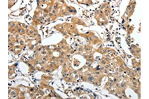 The image on the left is immunohistochemistry of paraffin-embedded Human lung cancer tissue using ABIN7192673(STEAP4 Antibody) at dilution 1/25, on the right is treated with synthetic peptide. (STEAP4 antibody)