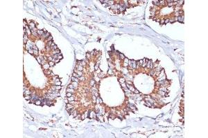 Immunohistochemistry of paraffin-embedded Human colon carcinoma using UBE2O Polyclonal Antibody at dilution of 1:100 (40x lens).