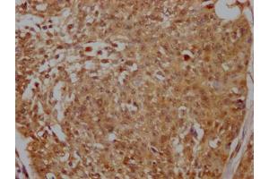 IHC image of ABIN7127675 diluted at 1:100 and staining in paraffin-embedded human cervical cancer performed on a Leica BondTM system. (Recombinant PELP1 antibody)