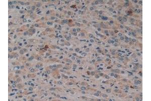 Detection of DNM2 in Human Prostate cancer Tissue using Polyclonal Antibody to Dynamin 2 (DNM2)