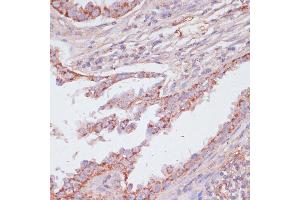 Immunohistochemistry of paraffin-embedded human lung cancer using C1 antibody (ABIN7265723) at dilution of 1:100 (40x lens). (ATP5C1 antibody  (AA 26-298))