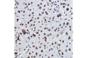 Immunohistochemistry of paraffin-embedded human liver cancer using EXOSC7 Rabbit mAb (ABIN7267064) at dilution of 1:100 (40x lens). (EXOSC7 antibody)