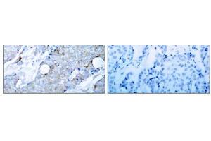 Immunohistochemical analysis of paraffin-embedded human breast carcinoma tissue using V (VEGFR2/CD309 antibody)