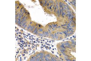 Immunohistochemistry of paraffin-embedded human colon cancer using HSPB8 antibody (ABIN5971347) at dilution of 1/200 (40x lens).