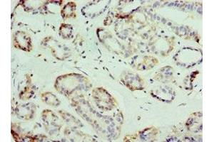 Immunohistochemistry of paraffin-embedded human breast cancer using ABIN7176713 at dilution of 1:100