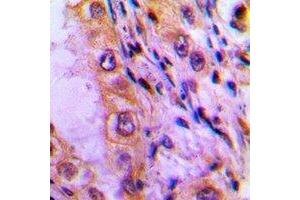 Immunohistochemical analysis of ATP5I staining in human lung cancer formalin fixed paraffin embedded tissue section. (ATP5I antibody)