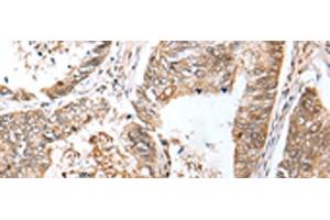 Immunohistochemistry of paraffin-embedded Human colorectal cancer tissue using LRRC19 Polyclonal Antibody at dilution of 1:30(x200) (LRRC19 antibody)