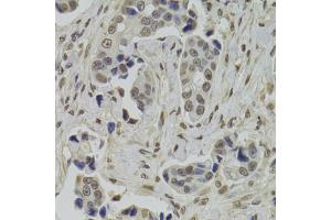 Immunohistochemistry of paraffin-embedded human breast cancer using INTS6 Antibody. (INTS6 antibody)