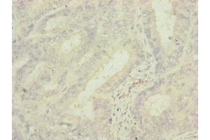 Immunohistochemistry of paraffin-embedded human endometrial cancer using ABIN7142279 at dilution of 1:100