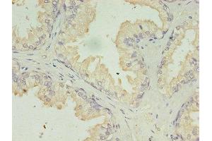 Immunohistochemistry of paraffin-embedded human prostate cancer using ABIN7142322 at dilution of 1:100
