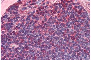 Human Colon, MALT (formalin-fixed, paraffin-embedded) stained with IL7R antibody ABIN351552 at 5 ug/ml followed by biotinylated goat anti-rabbit IgG secondary antibody ABIN481713, alkaline phosphatase-streptavidin and chromogen. (IL7R antibody  (C-Term))