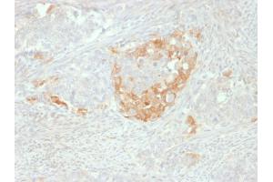 Formalin-fixed, paraffin-embedded human Neuroendocrine tumor stained with NSE gamma Mouse Monoclonal Antibody (NSE-P2). (ENO2/NSE antibody  (AA 416-433))