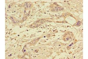 Immunohistochemistry of paraffin-embedded human pancreatic cancer using ABIN7169312 at dilution of 1:100 (PPP1CC antibody  (Catalytic Subunit))