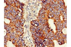Immunohistochemistry of paraffin-embedded human colon cancer using ABIN7144717 at dilution of 1:100 (Asparagine Synthetase antibody  (AA 364-551))