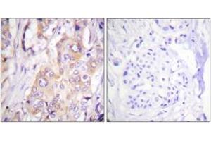 Immunohistochemistry analysis of paraffin-embedded human breast carcinoma, using MEK1 (Phospho-Thr286) Antibody.